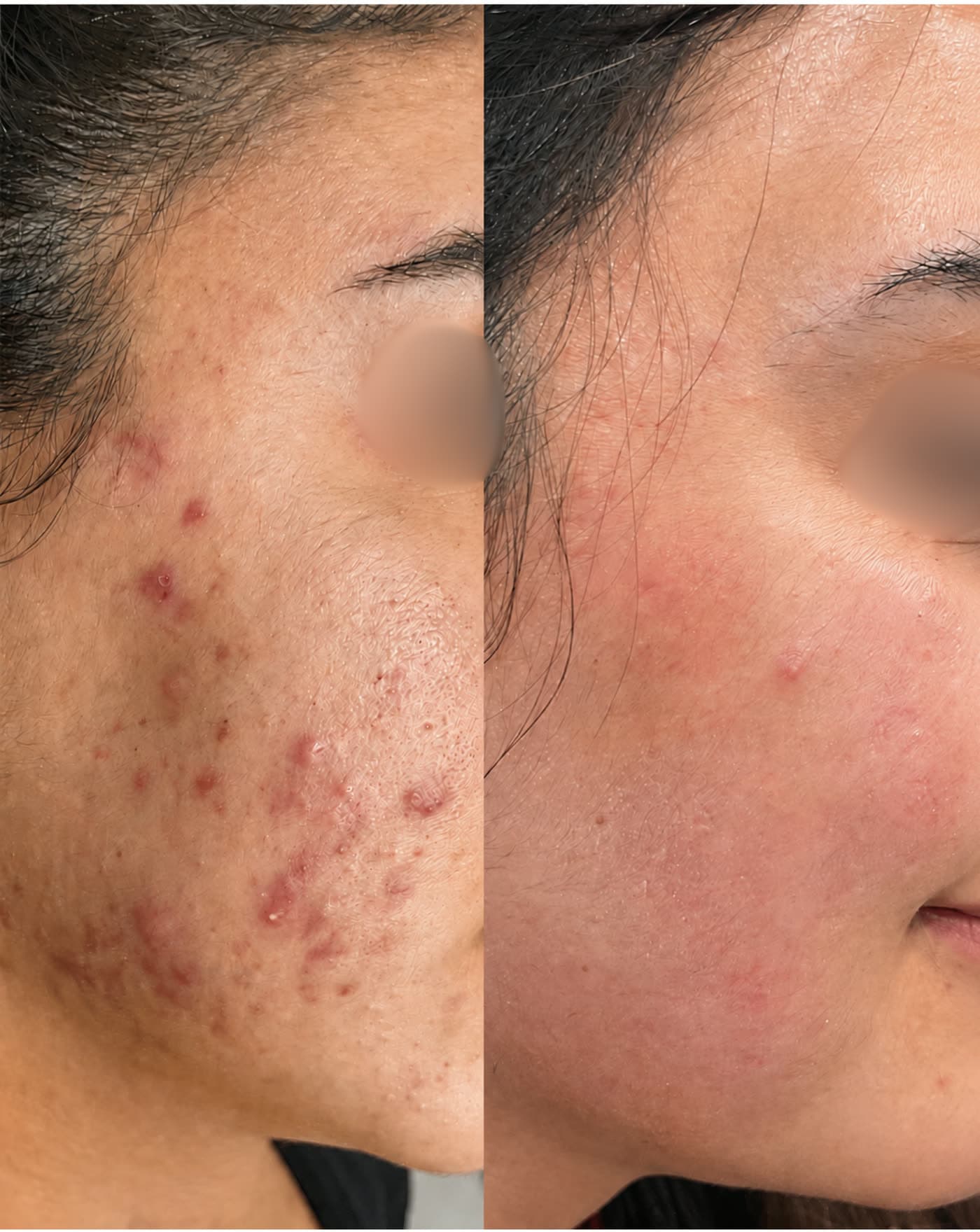 Before and after Anti-Acne Facial at Ora Medical Spa