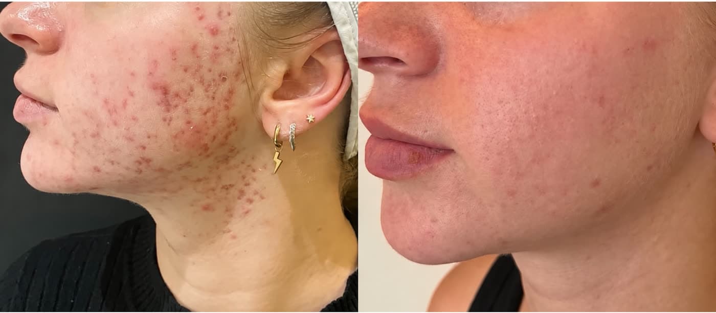 Before and after Anti-Acne Facial at Ora Medical Spa