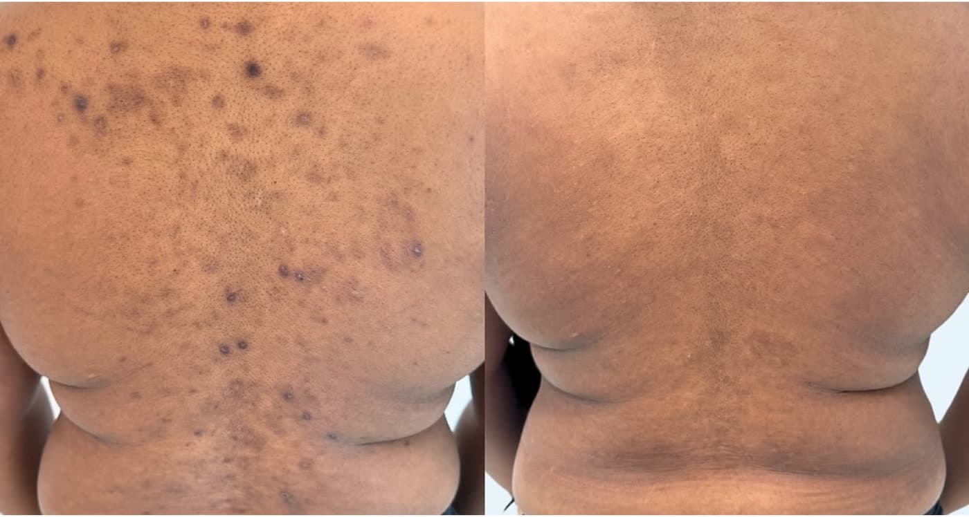 Before and after Clarifying Back Facial at Ora Medical Spa