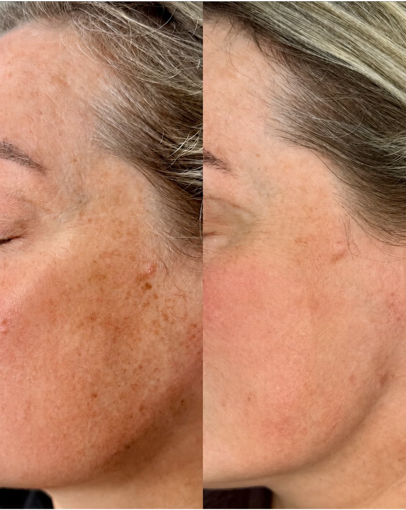 Before and after Brightening Facial at Ora Medical Spa