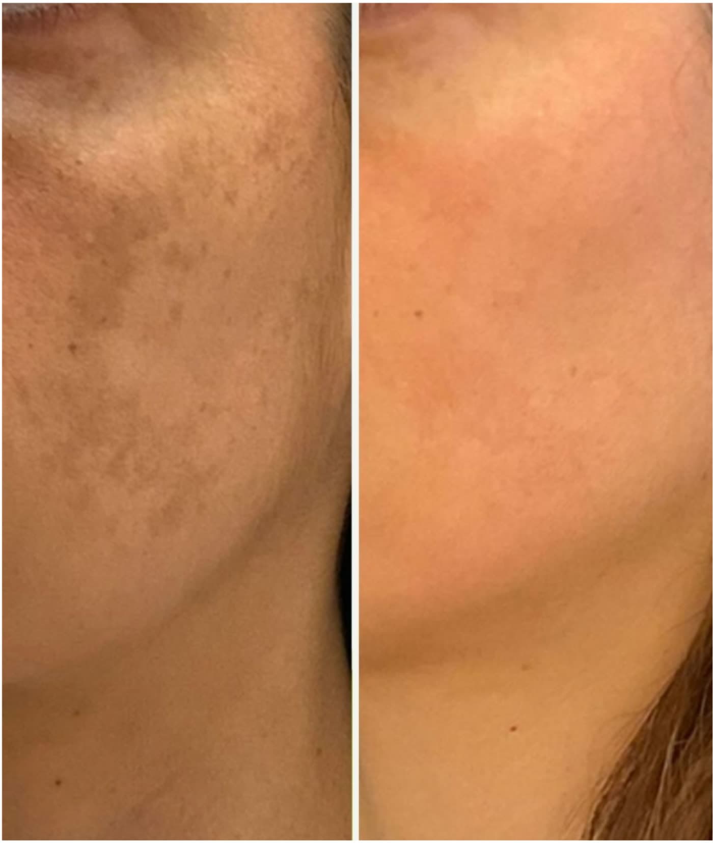 Before and after Brightening Facial at Ora Medical Spa