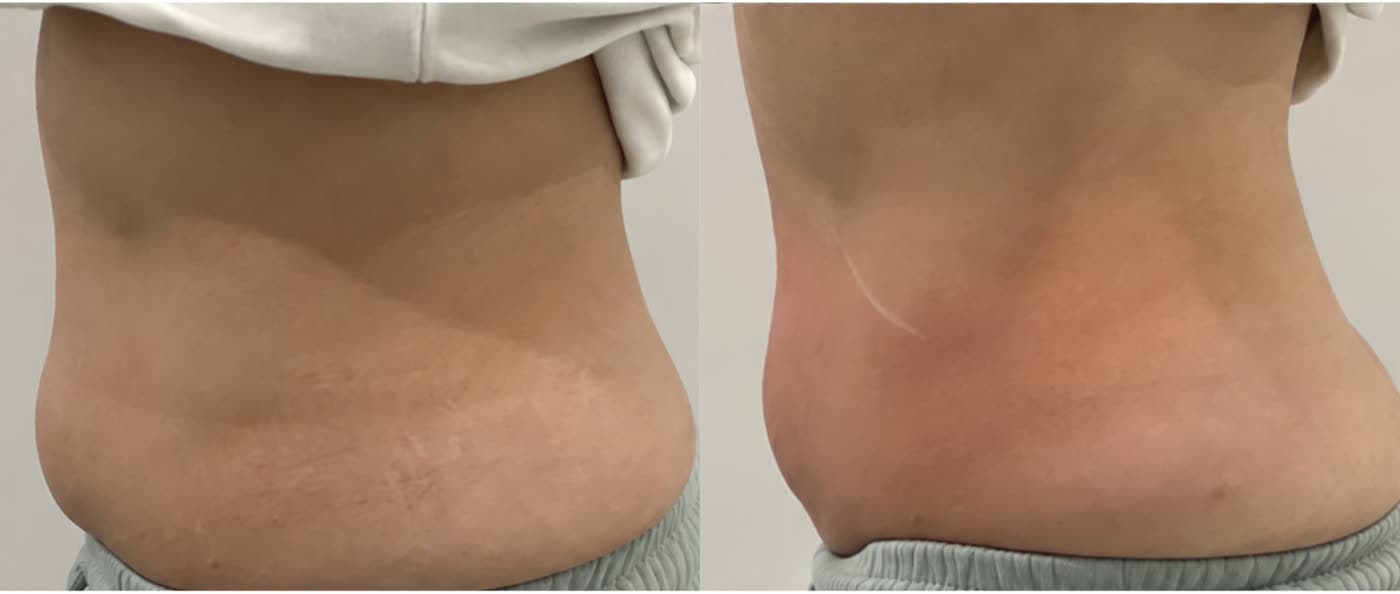 Before and after Cold Sculpting Fat Reduction at Ora Medical Spa