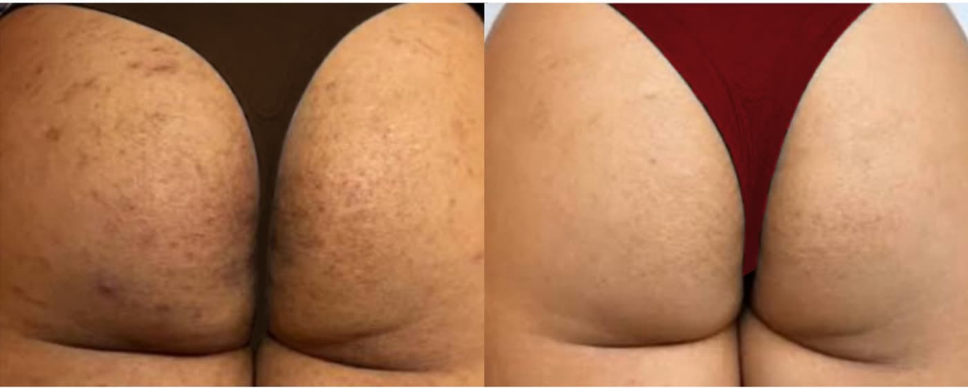 Before and after HydraBooty Treatment at Ora Medical Spa