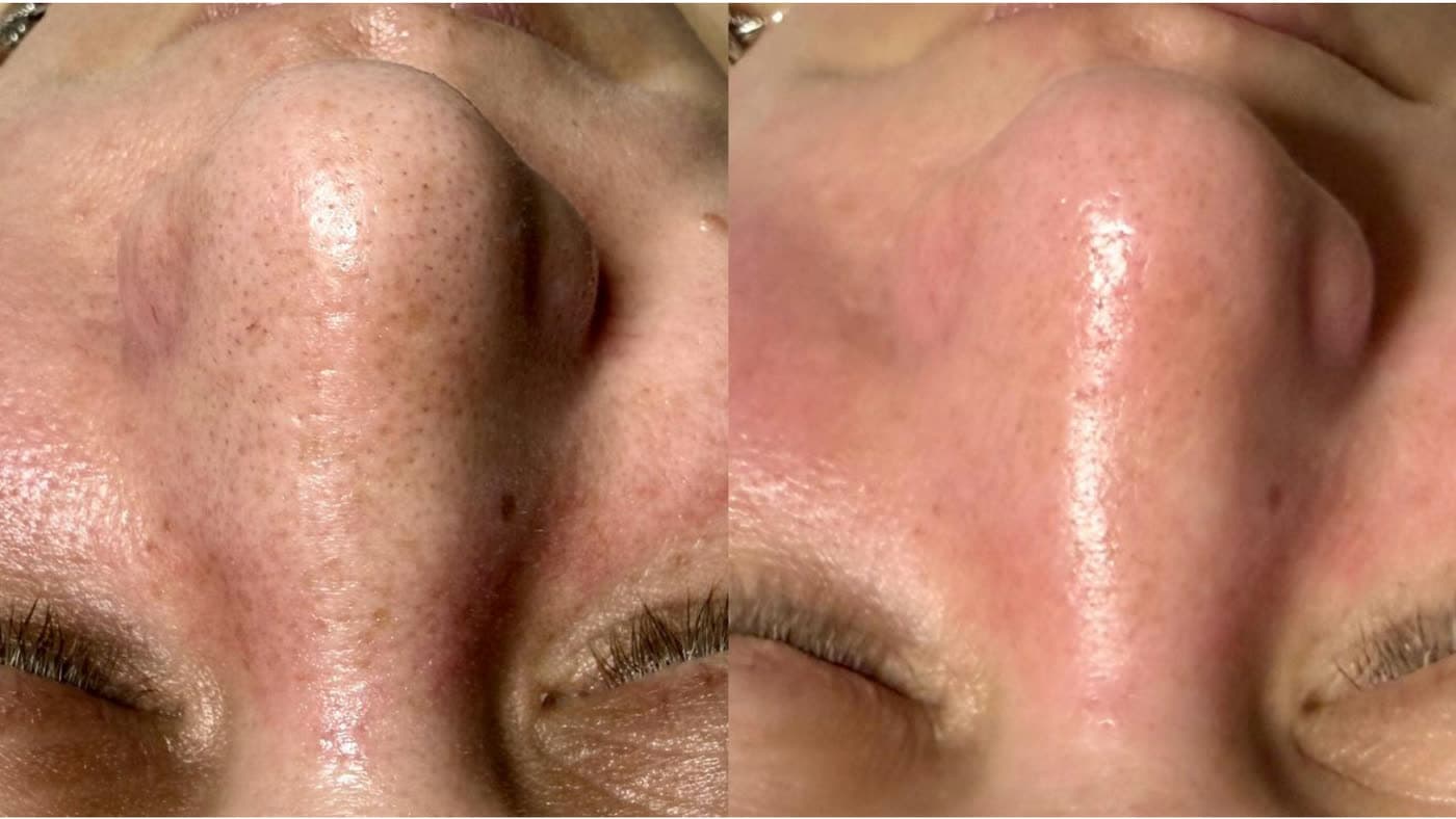 Before and after a HydraFacial at Ora Medical Spa