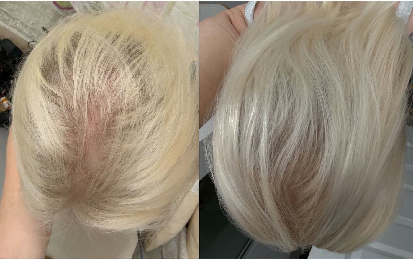 Before and after HydraFacial Keravive Scalp Treatment at Ora Medical Spa