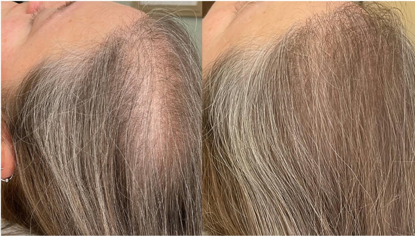 Before and after HydraFacial Keravive Scalp Treatment at Ora Medical Spa