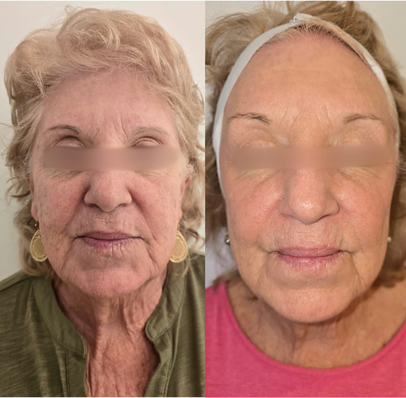 Before and after LED Age-Defying Facial at Ora Medical Spa
