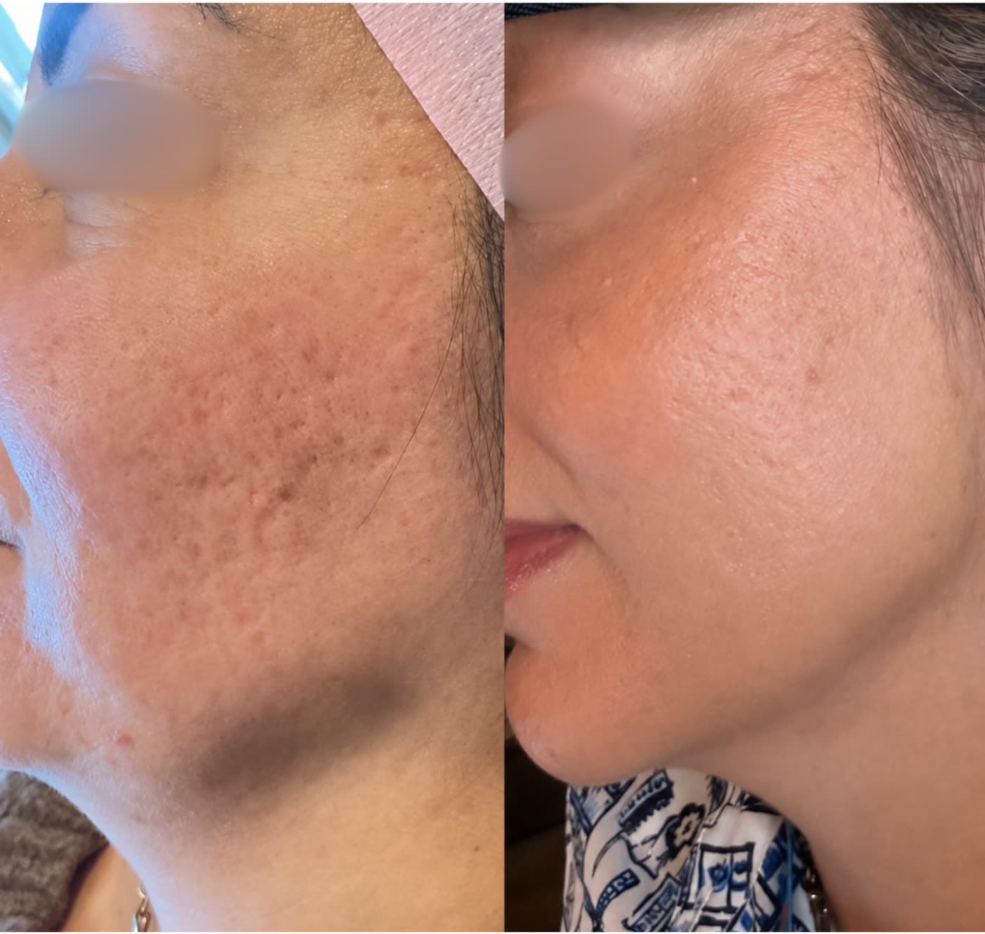 Before and after Microneedling Skin Renewal at Ora Medical Spa