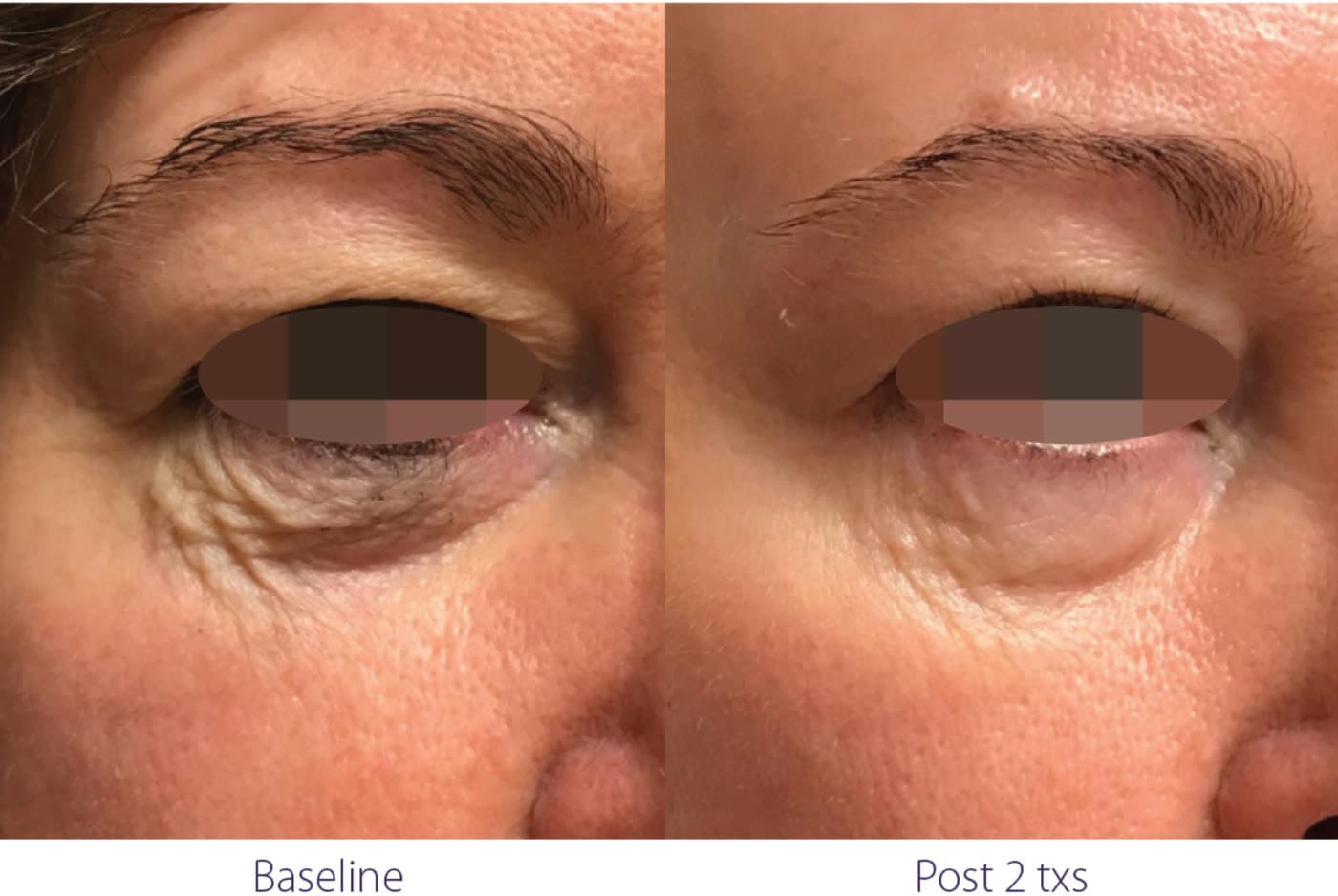 Before and after Opus Colibri Eye Rejuvenation at Ora Medical Spa