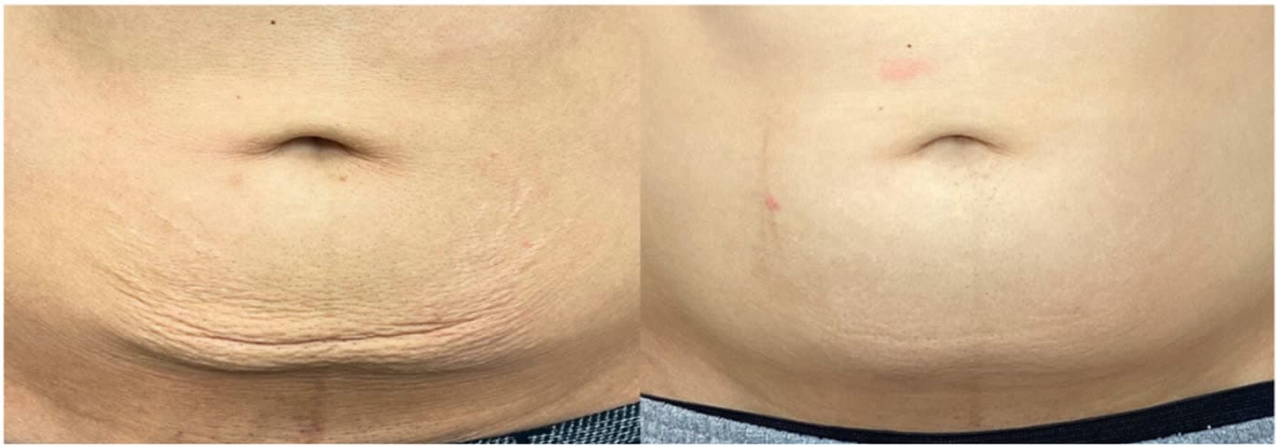 Before and after Focused Skin Resurfacing with Opus at Ora Medical Spa