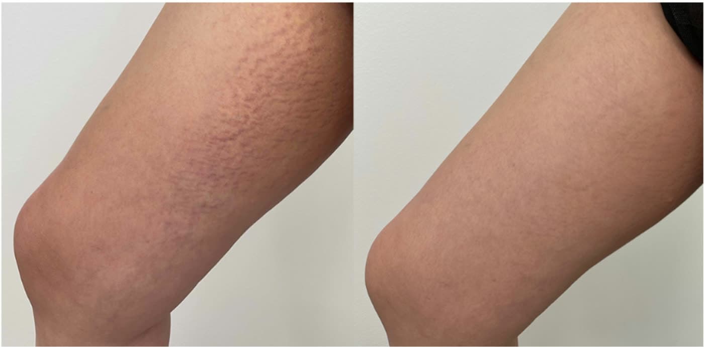 Before and after Focused Skin Resurfacing with Opus at Ora Medical Spa