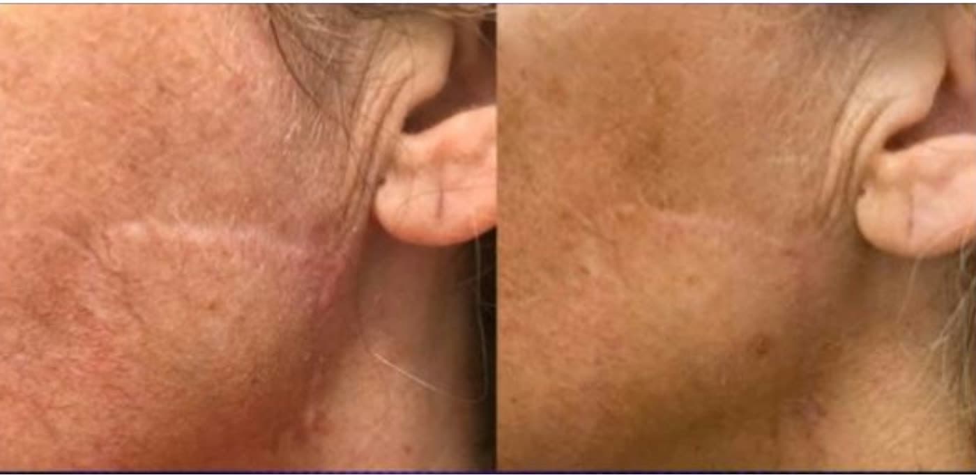 Before and after Focused Skin Resurfacing with Opus at Ora Medical Spa