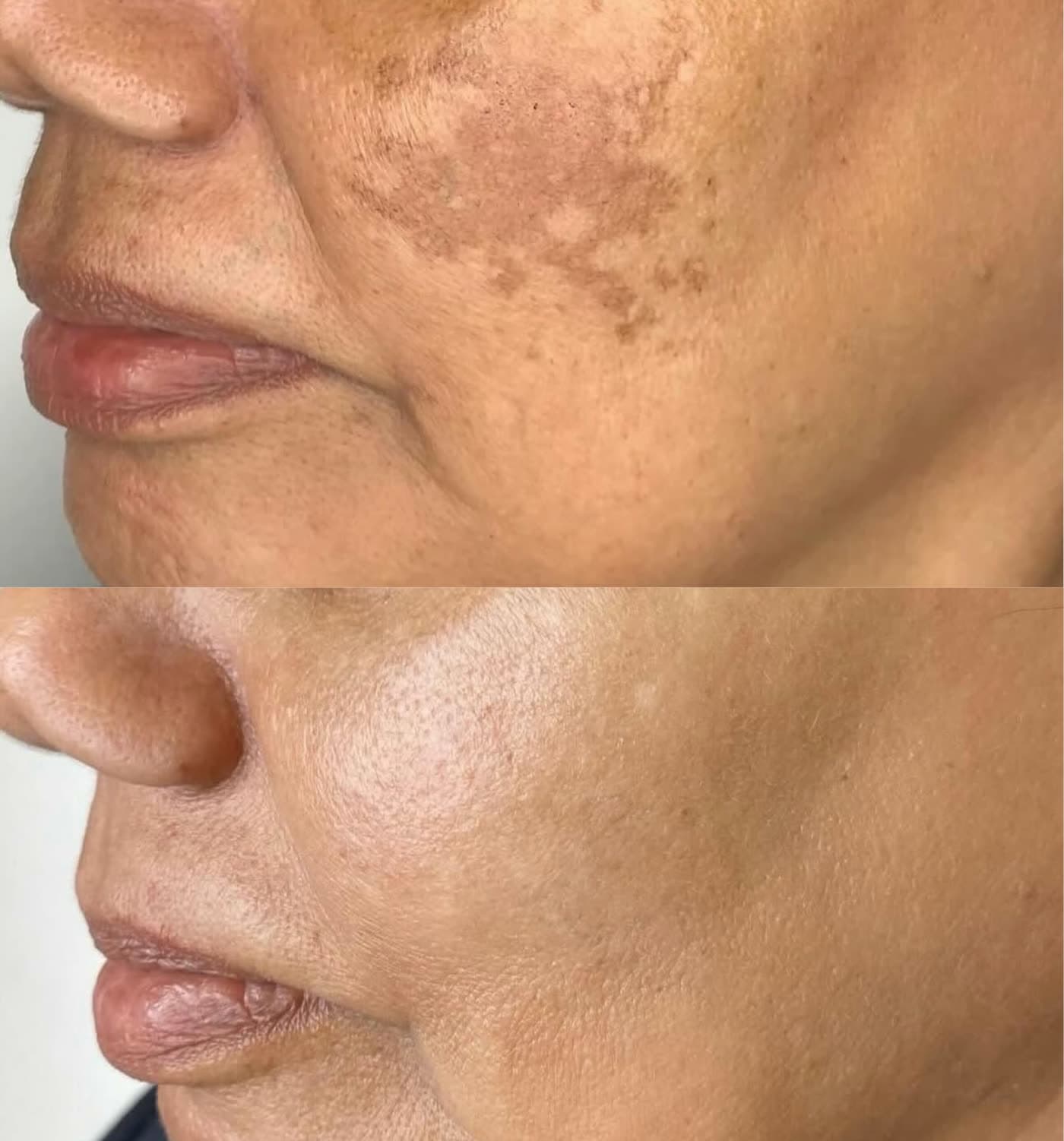 Before and after Opus Plasma Skin Resurfacing at Ora Medical Spa