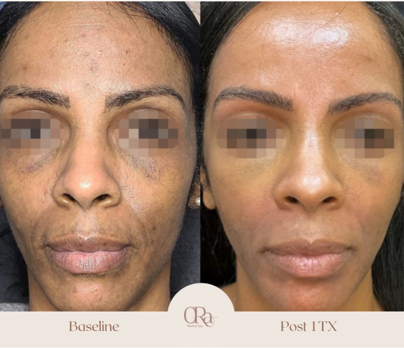 Before and after Opus Plasma Skin Resurfacing at Ora Medical Spa