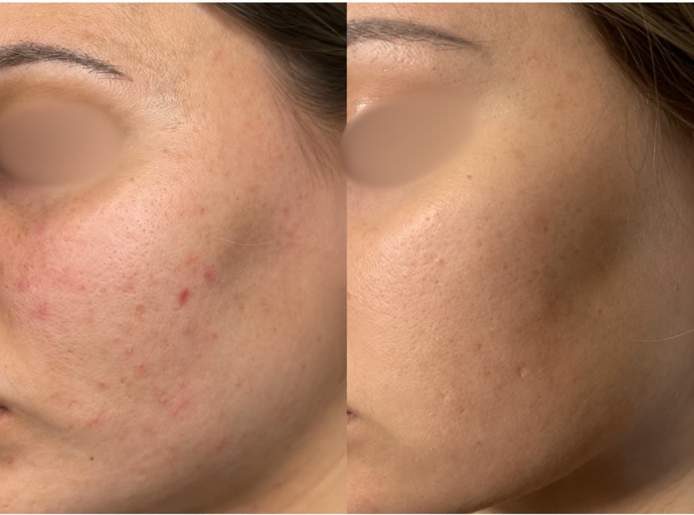 Before and after Oxygen Facial at Ora Medical Spa