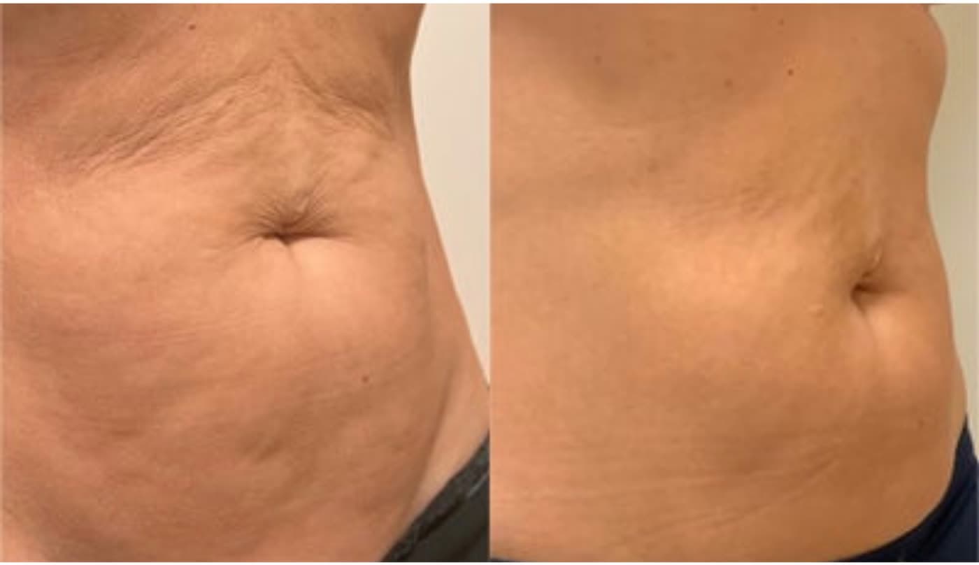 Before and after Radiofrequency Body Contouring at Ora Medical Spa