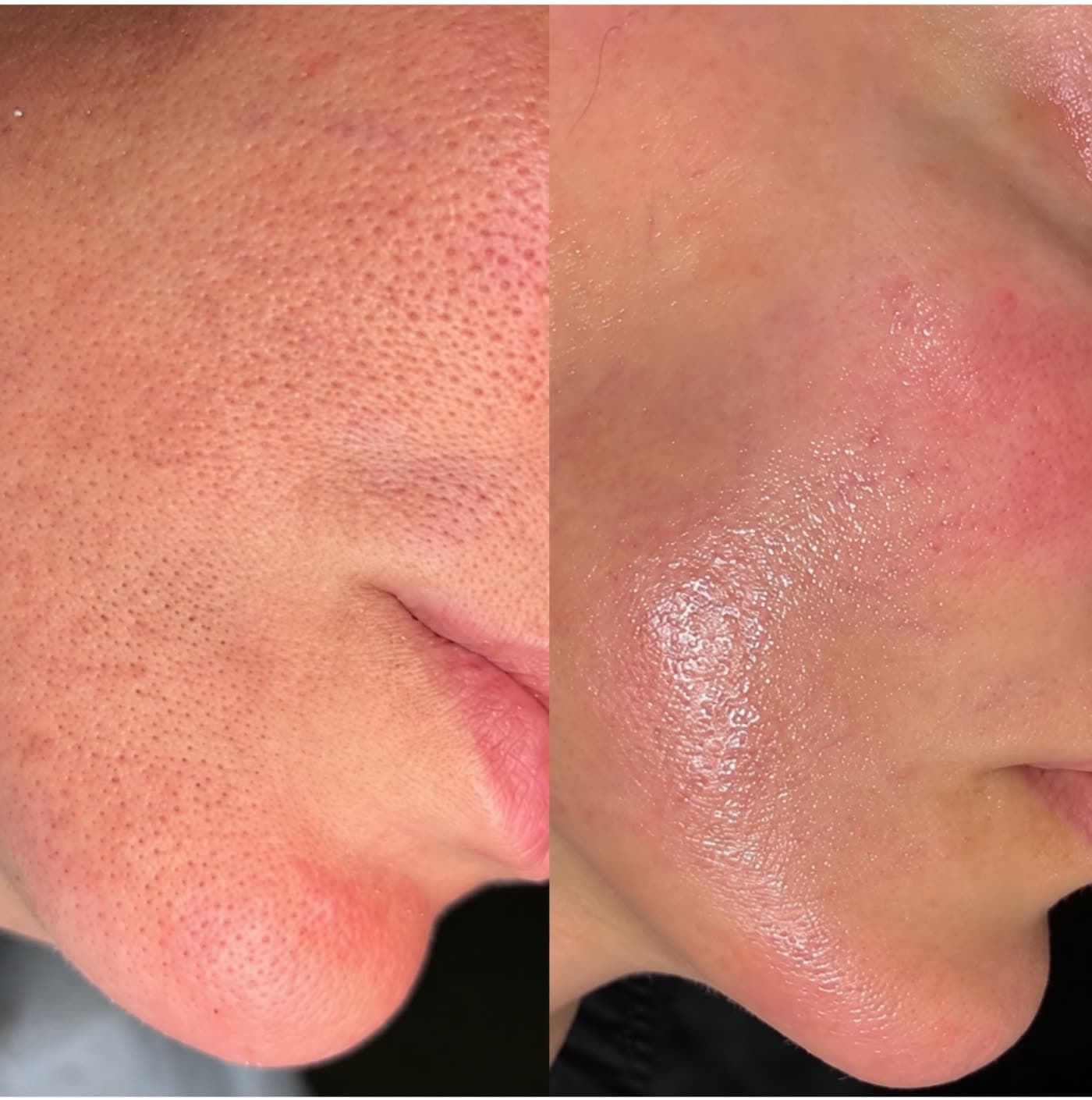 Before and after Stimulator Peel at Ora Medical Spa