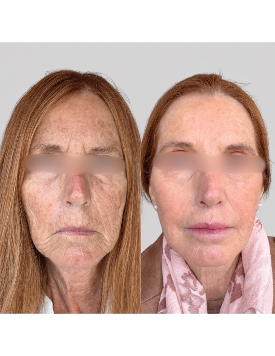 Before and after an RF Lifting Facial at Ora Medical Spa